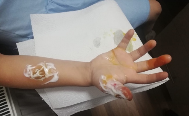 MR çekiminde parmakları ve kolu yandı